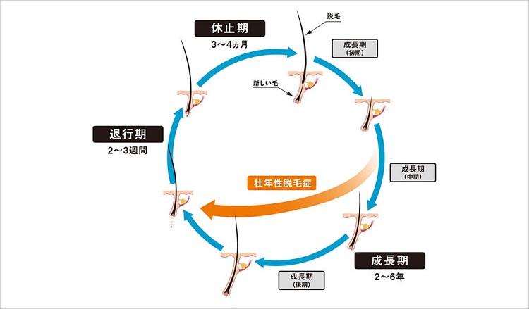 AGA治療薬「ザガーロ」の効果(2)男性型脱毛症の原因は?